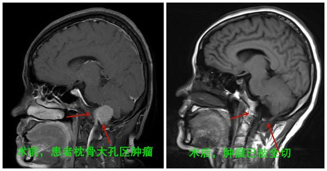 脖子不舒服以为是颈椎病真正“星空中国体育网站元凶”竟是脑肿瘤(图2)