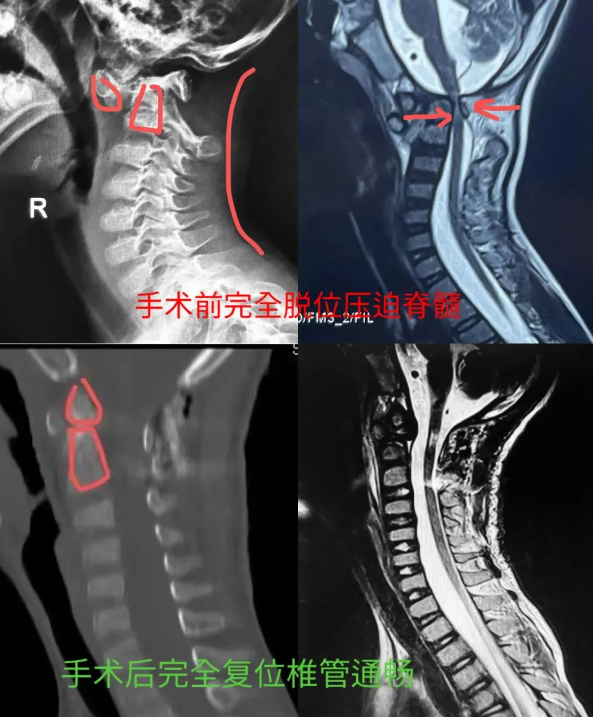 星空体育平台7岁男童突然高位截瘫 CT上看就像成了“断头人”病因是……(图1)